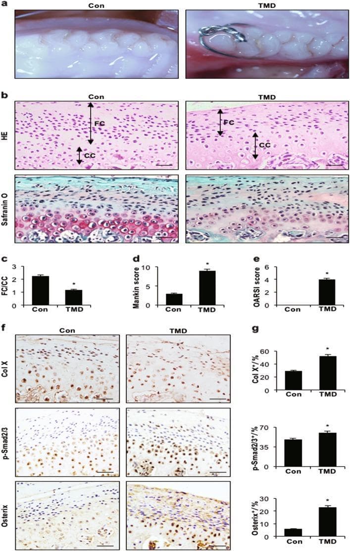 Educational figure illustrating cartilage degeneration in a rat model of temporomandibular disorder (TMD). Panel A shows clinical photographs of the molar occlusion relationship in control vs. TMD groups. Panel B presents histological sections of mandibular condylar cartilage: Haematoxylin and Eosin (HE) staining highlights a significantly decreased thickness of the fibrocartilage (FC) and calcified cartilage (CC) layers in TMD rats; Safranin O and fast green staining demonstrate a marked loss of red-stained proteoglycans in the TMD group, indicating cartilage degradation. Quantitative bar graphs (C-E) show a decreased FC/CC ratio and significantly elevated Mankin and OARSI scores in TMD samples. Panel F provides immunohistochemical (IHC) analyses of Col X, p-Smad2/3, and Osterix markers, where the TMD group exhibits increased brown chromogen intensity and higher positive cell counts (quantified in G). These findings demonstrate that abnormal occlusion triggers pathological remodeling and TGF-̢β/Smad pathway activation in the temporomandibular joint.
