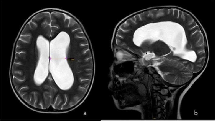 T2-weighted magnetic resonance imaging (MRI) of the brain in axial (a) and midsagittal (b) planes, demonstrating communicating hydrocephalus. The axial view displays a significant enlargement of the bilateral lateral ventricles, with cerebrospinal fluid (CSF) appearing as a high-intensity (bright white) signal relative to the darker brain parenchyma. Notably, the left lateral ventricle shows more pronounced dilatation compared to the right. The midsagittal view further highlights the global enlargement of the ventricular system, including prominent dilatation of the third and fourth ventricles, alongside widening of the suprasellar and prepontine cisterns. There is no evidence of an obstructive mass in the depicted sections. These neuroimaging findings are characteristic of altered CSF dynamics and increased intracranial pressure, clinically relevant in the context of neurological conditions like Guillain-Barré syndrome (GBS) which may present with elevated CSF protein levels leading to impaired resorption.