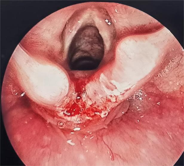 An intraoperative endoscopic view of the larynx and posterior pharyngeal region during a surgical repair of a laryngeal cleft. The image demonstrates a fresh, longitudinal incision made along the mucosal border of the interarytenoid area, extending toward the esophageal inlet. The vocal cords are visible as whitish, longitudinal bands flanking the airway opening. The surgical site displays characteristic signs of recent intervention, including focal erythema, disrupted tissue margins with a raw texture, and small amounts of serosanguinous fluid and bubbles, likely from irrigation or needle-tip electrocautery denudation. This image illustrates a critical preparatory step in laryngeal cleft closure—creating fresh, denuded wound edges to facilitate subsequent primary suturing and tissue apposition. The visual focus is on the anatomical relationship between the laryngeal airway, the posterior cleft, and the adjacent esophageal opening in a pediatric or clinical context.