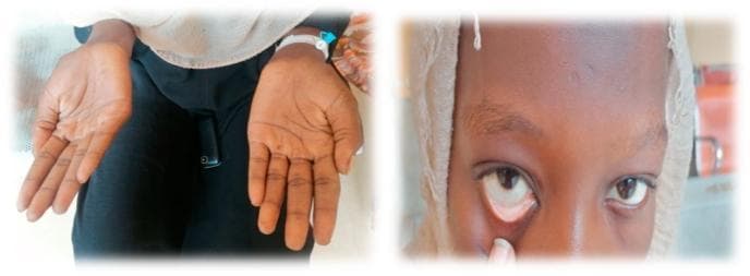 This composite clinical photograph illustrates common physical examination findings associated with severe anemia. The left panel shows the bilateral palms of a patient, demonstrating marked palmar pallor. The skin on the palms and creases appears significantly lighter and lacks the typical pinkish hue of healthy vascularized tissue, suggesting reduced hemoglobin concentration. The right panel is a close-up of the patient's face with the lower eyelid retracted to reveal the palpebral conjunctiva. Instead of the normal vibrant red or pink color, the conjunctiva exhibits conjunctival pallor, appearing whitish or very pale pink. These visual signs are critical diagnostic markers in hematology and general medicine for identifying systemic conditions such as iron-deficiency anemia or other forms of chronic blood loss. The image serves as a teaching tool for medical students and clinicians to recognize mucosal and cutaneous indicators of decreased red blood cell mass or oxygen-carrying capacity.