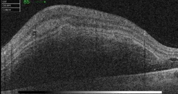 An optical coherence tomography (OCT) cross-sectional scan of the retina showing significant pathological structural alterations. The image demonstrates a massive, convex elevation of the retinal layers caused by a large accumulation of material. Key findings include dense, diffuse hyper-reflectivity localized within the inner retinal layers and the sub-retinal space, consistent with multi-layered (intra-retinal and sub-retinal) hemorrhage. This hyper-reflective material causes significant posterior shadowing, which obscures the underlying details of the outer retina, retinal pigment epithelium (RPE), and choroid. Adjacent to the primary mass, a sub-foveal area of hypo-reflectivity is visible, indicating the presence of sub-retinal serohematic fluid. The normal foveal contour and layered retinal architecture are severely disrupted. This diagnostic image is characteristic of acute macular hemorrhage, often associated with vascular conditions like retinal artery macroaneurysm (RAM) or wet age-related macular degeneration (AMD).