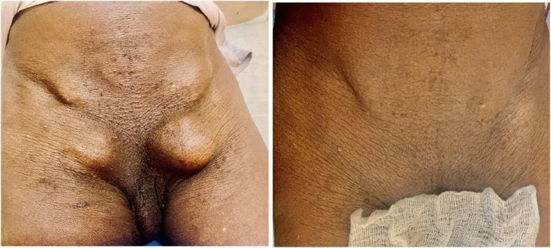 A clinical photograph comparison demonstrating bilateral inguinal and femoral hernias in an adult male, categorized under general surgery and anatomy. The preoperative image (left) shows four distinct ovoid swellings in the groin region. Superiorly, bilateral inguinal swellings are visible above the inguinal ligament. Inferior to these, bilateral femoral swellings are prominent in the femoral triangles, lateral to the pubic tubercle. The swellings are well-defined and raised, with skin stretched over the masses. The postoperative image (right) displays the resolution of these protrusions following surgical repair. The skin across the lower abdomen and inguinal region exhibits signs of aging, including pronounced skin folds, wrinkles, and scattered small seborrheic keratoses or skin tags. This visual serves as a clear educational example of complex pelvic floor hernias and the anatomical distinction between inguinal and femoral hernia locations.