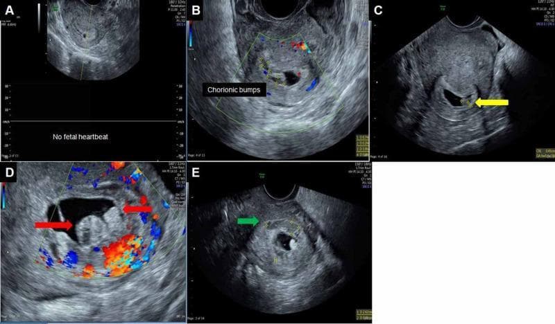 This composite diagnostic image displays five panels (A-E) of transvaginal ultrasound scans illustrating early first-trimester pregnancy complications. Panel A shows an initial presentation of a 3 mm gestational sac without a fetal heartbeat. Panels B, C, and D demonstrate the sonographic appearance of 'chorionic bumps'—convex lesions protruding from the chorionic wall into the gestational sac cavity. These lesions feature a characteristic central hypoechoic region with a peripheral hyperechoic rim; Color Doppler in panels B and D confirms an absence of internal vascularity within these protrusions. Panel E identifies a subchorionic hematoma, indicated by a green arrow, appearing as a heterogeneously hypoechoic area located outside the chorion without internal blood flow. The collection serves as an educational resource for identifying a chorionic bump, a finding associated with an increased risk of first-trimester pregnancy loss, and distinguishing it from other gestational structures or subchorionic hemorrhage.