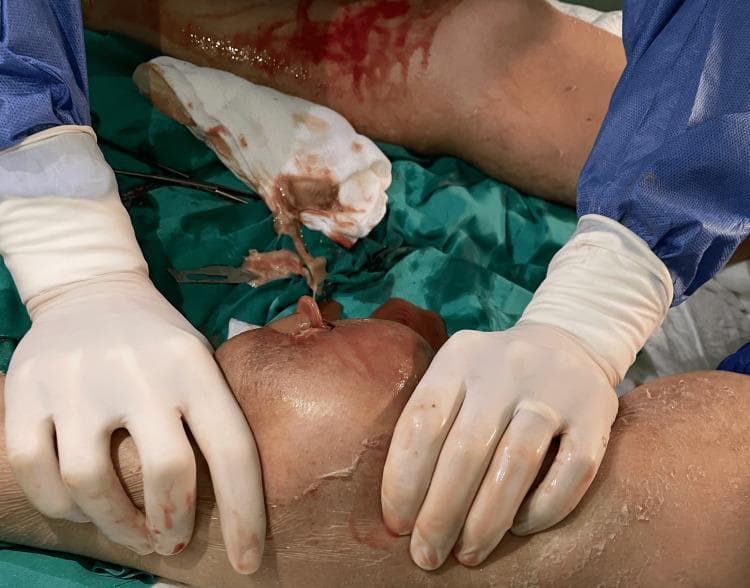 This clinical photograph captures a surgical procedure involving the drainage of a lower limb abscess. The central focus is an inflamed, erythematous, and significantly indurated area of skin on the leg where an incision has been made. A surgical drain (Penrose or similar) is seen emerging from the incision site, accompanied by hematopurulent drainage. The surrounding skin exhibits signs of inflammation and desquamation, partially covered by transparent adhesive dressing remnants. Medical personnel are shown performing the procedure wearing sterile white gloves and blue surgical gowns. The operative field is defined by green sterile drapes, upon which a scalpel and blood-stained gauze are visible. This image illustrates surgical management of deep-seated soft tissue infections or muscular abscesses, highlighting clinical findings of cellulitis, localized inflammation, and the technique for establishing drainage to manage purulent collections. It serves as an educational example of bedside or operating room intervention for complicated skin and soft tissue infections (SSTIs).