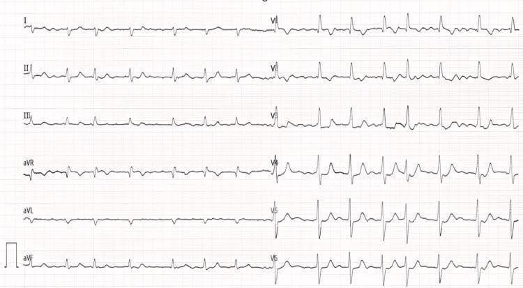 A 12-lead electrocardiogram (ECG) demonstrating a cardiac arrhythmia and signs of right ventricular strain. The tracing shows atrial fibrillation, characterized by an irregularly irregular rhythm and the absence of distinct P waves, replaced by fine fibrillatory waves most visible in leads II, III, and aVF. There is a notable right-axis deviation (negative QRS in lead I, positive in aVF) and an incomplete right bundle branch block (RSR' pattern in lead V1 with a narrow QRS duration). T-wave inversions are present in the right precordial leads (V1, V2, and V3), which is a common finding in right ventricular overload. The QRS morphology in the precordial leads shows a transition with S-waves persisting through V6 and the largest R-wave amplitude in V6. These features collectively suggest right heart strain, often associated with conditions like pulmonary hypertension or congenital heart defects such as atrial septal defects.