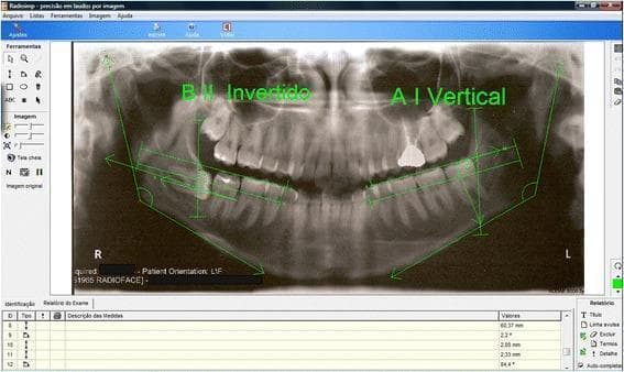 This diagnostic image is a panoramic radiograph (orthopantomogram) displayed within Radioimpยฎ dental analysis software, illustrating the radiological classification of impacted mandibular third molars (M3). The image features green digital overlays used to determine tooth position based on the Pell & Gregory and Winter classifications. On the patient's right mandible, the third molar is annotated as 'B II Invertido', indicating a horizontal or inverted orientation with partial impaction relative to the ascending ramus and occlusal plane. On the left side, the tooth is labeled 'A I Vertical', signifying a vertical eruption path with sufficient space and an occlusal level consistent with the second molar. Key reference lines visible include the occlusal plane, the anterior border of the mandibular ramus, and the longitudinal axes of the third molars. These measurements facilitate clinical assessment of pericoronal radiolucency, root development (Nolla stages), and surgical difficulty for third molar extraction in oral and maxillofacial surgery.