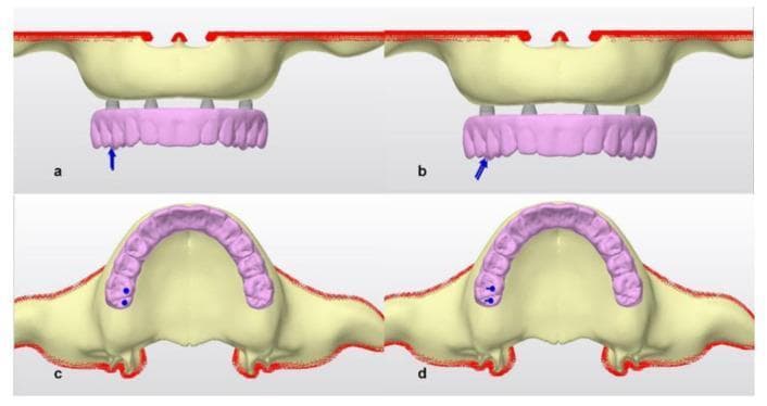 A medical illustration presenting a biomechanical study of an 'all-on-four' dental implant concept in an edentulous maxilla. The image is divided into four panels (a-d) showing virtual models of a maxillary bone (pale yellow) with four dental implants and a hybrid pink dental prosthesis attached via multiunit abutments. Panels (a) and (b) provide a frontal view, where blue arrows indicate the application of external forces: a strictly vertical force in (a) and an oblique force in (b), both targeted at the posterior region of the prosthesis. Panels (c) and (d) provide an occlusal (superior) view of the same setup, with blue circular markers and small vectors representing the top-down perspective of the vertical force in (c) and the oblique force in (d). This comparison is designed to demonstrate how different loading vectors (vertical vs. oblique) affect stress distribution across the prosthesis framework, abutments, and surrounding cortical bone, serving as an educational resource for dental implantology and prosthodontic planning.