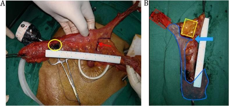 Clinical photograph and mapping diagram of a surgically resected rectal cancer specimen. Image A shows the tumor-bearing bowel segment extracted from the abdominal cavity. A yellow circle identifies the primary tumor site, where carbon nanoparticles were injected for lymph node tracing. A red arrow marks a point 10 cm proximal to the tumor on the bowel wall, with a surgical ruler alongside to ensure accurate margin measurement. Image B illustrates lymph node mapping on the fresh specimen using colored overlays. The red area demarcates the Main Lymph Nodes (MLNs) along the inferior mesenteric artery (IMA) from the left colic artery (LCA) origin to the IMA root. The blue area outlines the Superior Rectal and Perirectal Lymph Nodes (SPLNs). The yellow area identifies Pericolic Lymph Nodes (PCNs) located beyond the 10 cm proximal marker (indicated by a blue arrow). This visual illustrates oncologic resection standards and lymph node harvesting protocols for colorectal adenocarcinoma.