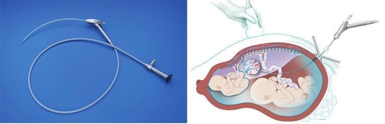 This composite educational resource features a photograph of a curved fetoscope and an anatomical diagram demonstrating its clinical application in fetal surgery. The photograph (left) shows a semi-flexible curved scope with a metallic proximal handle containing control ports and a distal tip designed for angled visualization. The diagram (right) illustrates the use of this curved fetoscope for treating Twin-to-Twin Transfusion Syndrome (TTTS) in a pregnancy with an anterior placenta. It depicts the scope passing through the abdominal and uterine walls into the amniotic cavity under ultrasound guidance (indicated by the transducer on the maternal abdomen). The trajectory of the curved scope is specifically shown to achieve a perpendicular orientation to the anterior placenta, facilitating the identification and laser coagulation of superficial vascular anastomoses on the chorionic plate between the donor and recipient twins. This specialized instrumentation allows for improved surgical access when anatomical positioning of the placenta limits the utility of traditional straight endoscopes.
