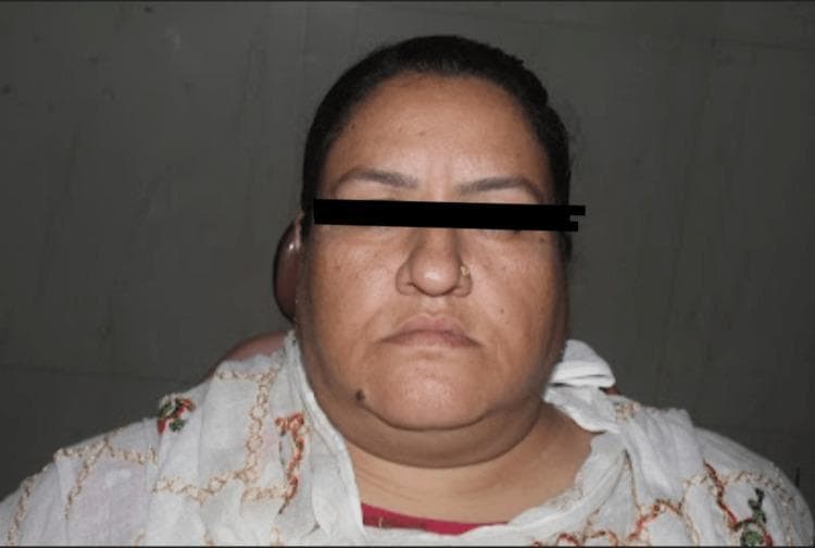 This clinical photograph shows a front-view extraoral assessment of a 38-year-old female patient exhibiting classic signs of facial myxedema and weight gain associated with uncontrolled hypothyroidism. The facial contour is noticeably rounded, presenting a 'moon face' appearance with generalized fullness and obscuration of the underlying bony jawline and malar landmarks. Key visible features include bilateral periorbital puffiness, prominent soft tissue swelling in the cheeks (buccal fat pad region), and increased subcutaneous adipose tissue in the submental and cervical areas, leading to a less defined neck-to-jaw transition. The skin appears somewhat thickened with diffuse hyperpigmentation, particularly across the malar regions. These findings are characteristic clinical manifestations of thyroid dysfunction, reflecting the systemic metabolic effects and mucopolysaccharide deposition in dermal tissues. This visual material serves as an educational reference for identifying secondary systemic symptoms during a dental or general medical examination, specifically in patients with comorbid diabetes mellitus and hypothyroidism.