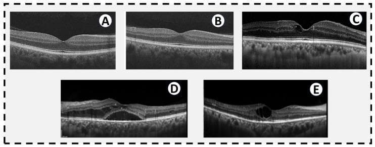 A comparison of five cross-sectional Spectral Domain Optical Coherence Tomography (OCT) scans of the macula, illustrating the structural progression of diabetic retinopathy (DR). (A) Normal retina with a clear foveal depression and intact stratified layers. (B) Early changes in a diabetic patient showing altered reflectivity and subtle layer thickening without overt edema. (C) Mild non-proliferative diabetic retinopathy (NPDR) exhibiting a focal cystic space within the inner retinal layers at the fovea. (D) Severe NPDR characterized by significant diabetic macular edema (DME), visible as a large hyporeflective subretinal fluid pocket and diffuse intraretinal thickening. (E) Proliferative diabetic retinopathy (PDR) demonstrating a large intraretinal cyst, hyperreflective foci representing lipid exudates in the temporal macula, and inner retinal thinning suggestive of macular ischemia. The series highlights key diagnostic features including macular edema, subretinal fluid, hard exudates, and neurosensory architectural distortion.
