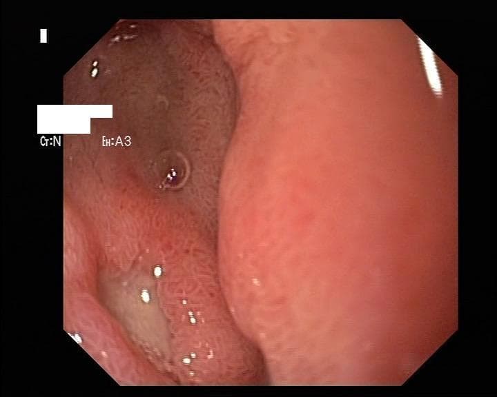 This endoscopic clinical photograph displays a peptic ulcer located within the duodenal mucosa. The diagnostic image reveals a well-circumscribed, depressed ulcer bed characterized by a yellowish-white fibrin base, which indicates tissue necrosis or inflammatory exudate. The surrounding duodenal wall exhibits significant erythema and hyperemia, suggesting localized inflammation of the mucosal lining. The adjacent mucosa displays a granular, slightly cobblestone texture typical of the small intestine, though with visible reactive changes. Notable incidental findings include a small, translucent circular air bubble or mucous collection near the ulcer site. This visual illustrates a classic complication of non-steroidal anti-inflammatory drug (NSAID) therapy in an elderly patient. The educational focus is on the endoscopic identification of upper gastrointestinal pathology, specifically the morphological characteristics of a duodenal ulcer in the context of drug-induced mucosal injury.