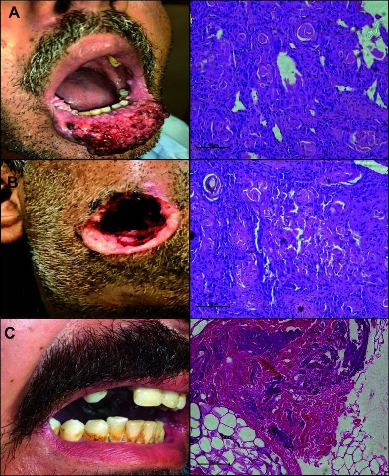 A medical comparison chart illustrating Oral Squamous Cell Carcinoma (OSCC) through clinical photographs (left column) and corresponding histopathological H&E stained slides (right column), categorized by tumor differentiation grades. Panel A demonstrates well-differentiated OSCC, showing an exophytic, irregular, and erythematous mass on the lower lip; the microscopy reveals nests of squamous cells with distinct keratin pearls. Panel B shows moderately differentiated OSCC with an extensive, deep ulcerative lesion of the chin/perioral region and histological features including disorganized cellular arrangements and fewer keratinization signs. Panel C represents poorly differentiated OSCC, showing severe dental decay and gingival recession clinically; the histopathology displays highly pleomorphic cells with a loss of typical squamous architecture, increased cellular dispersion, and invasion into underlying adipose tissue (visible as clear adipocytes). This visual resource is designed for dental and oncological education to correlate gross clinical presentations of oral malignancy with microscopic grading based on cellular morphology and tissue organization.