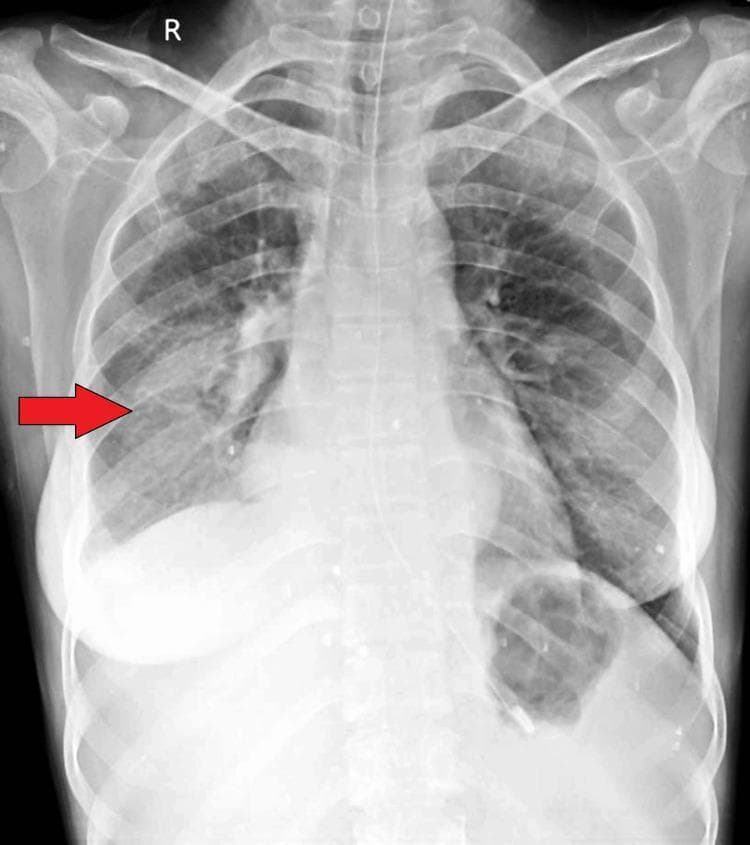 This diagnostic image is a posterior-anterior (PA) chest radiograph illustrating a significant pathological finding in the lower right lung field. A red arrow points to a large, dense, and relatively homogenous opacity localized in the right lower lobe, which partially obscures the right hemidiaphragm and costophrenic angle. This radiographic appearance is consistent with pulmonary consolidation, which can be seen in conditions such as pneumonia, aspiration, or complications arising from a bronchoesophageal fistula (BEF). The cardiac silhouette appears centrally located, and the left lung field remains relatively clear without overt consolidation or effusion. Bony structures, including the clavicles and ribs, appear intact. This image serves as a clinical teaching tool for identifying lobar opacification and its differential diagnoses in patients presenting with respiratory symptoms like cough or fever. The visibility of the gastric bubble and tracheal alignment provide additional anatomical landmarks for standard chest X-ray interpretation.