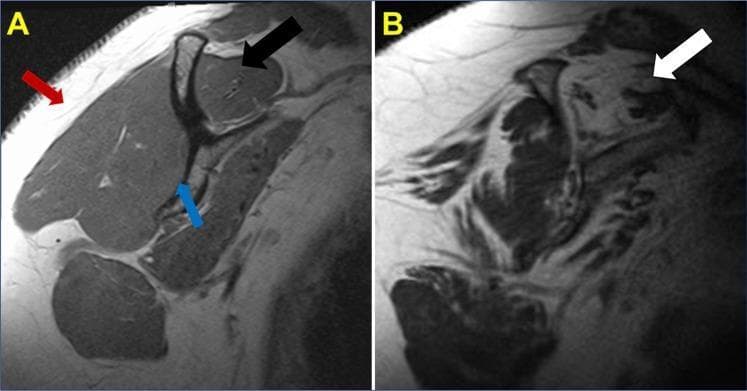 This diagnostic image consists of two side-by-side sagittal T1-weighted MRI scans of the shoulder, illustrating the differences between healthy rotator cuff musculature and a chronic massive rotator cuff tear. Panel A shows a healthy shoulder: a black arrow identifies the supraspinatus muscle belly with characteristic low signal intensity (dark appearance); a red arrow indicates hyperintense (bright) subcutaneous fat; and a blue arrow marks the body of the scapula. Panel B demonstrates pathological changes associated with a chronic, massive rotator cuff tear. A white arrow highlights significant fatty infiltration and muscle atrophy within the supraspinatus. In this pathological state, the muscle tissue exhibits a high signal intensity similar to the surrounding subcutaneous fat, indicating replacement of muscle fibers with adipose tissue. This comparison is clinically significant for diagnosing Goutallier stages of fatty degeneration in musculoskeletal radiology and orthopedics, helping to assess the prognosis and surgical reparability of chronic rotator cuff injuries.