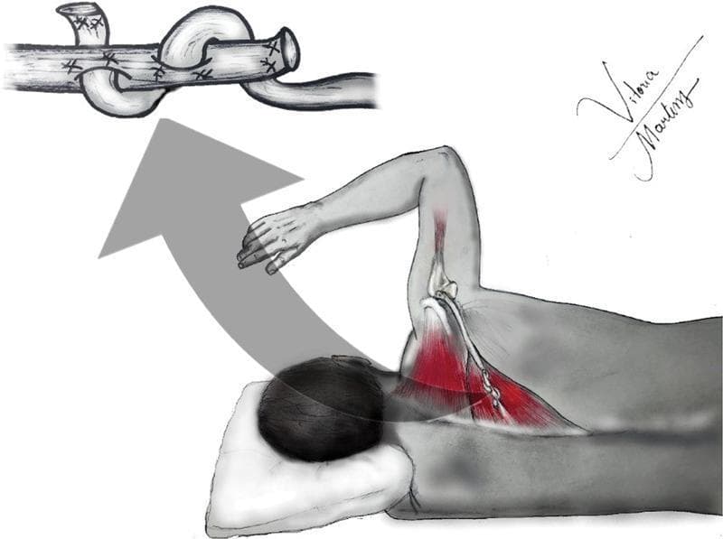 This medical illustration depicts the surgical technique and functional anatomy of a lower trapezius transfer for shoulder reconstruction. The main diagram shows a patient in a lateral decubitus position, demonstrating active external rotation of the arm. Anatomical highlights in red illustrate the lower fibers of the trapezius muscle being utilized as a tendon transfer to restore shoulder function, specifically targeting irreparable rotator cuff tears where external rotation is lost. The muscle is shown transitioning into a graft that extends toward the humerus. An inset at the top provides a detailed view of the surgical fixation method, illustrating a weave-style tendinous anastomosis (likely a Pulvertaft weave) secured with sutures to join the donor tendon to the recipient site. This procedure is indicated for patients with posterosuperior rotator cuff insufficiency, providing a biomechanical advantage for external rotation when the infraspinatus and teres minor are non-functional.