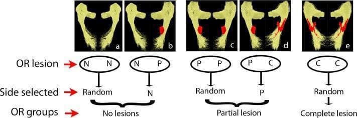This figure is a diagnostic neuroimaging diagram illustrating the selection criteria for analyzing the optic radiation (OR) based on lesional involvement. The visual content consists of five axial diffusion tensor imaging (DTI) reconstructions of the optic radiations (labeled a-e) and a corresponding decision flowchart. In the DTI frames, the OR is rendered in yellow, while focal lesions are highlighted in red. The flowchart categorizes cases into three study groups: 'No lesions', 'Partial lesion', and 'Complete lesion'. In the 'No lesions' group (a-b), the selection prioritizes non-lesional (N) sides. The 'Partial lesion' group (c-d) focuses on tracks with partial (P) involvement over complete (C) lesions. The 'Complete lesion' group (e) demonstrates bilateral, full cross-sectional involvement. This material is designed for advanced medical education in neurology and neuroradiology, specifically demonstrating how to standardize fiber tract analysis in patients with multiple sclerosis or other white matter pathologies affecting the visual pathways between the lateral geniculate nucleus and the primary visual cortex.