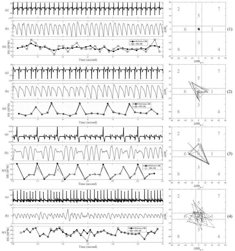 A multi-panel clinical diagnostic chart comparing four cardiac rhythm states using data from a smartwatch. The panels represent: (1) Normal Sinus Rhythm (NSR), (2) Premature Atrial Contractions (PAC), (3) Premature Ventricular Contractions (PVC), and (4) Atrial Fibrillation (AF). Each panel consists of three synchronized physiological signal segments: (a) a single-lead electrocardiogram (ECG) trace showing QRS morphology, (b) a photoplethysmogram (PPG) pulse waveform, and (c) a heart rate (BPM) over time graph comparing reference HR vs. PPG HR. To the right of each panel is a Poincaré plot, which visualizes pulse interval variability. The NSR panel shows high regularity with a tight central cluster on the Poincaré plot. The PAC and PVC panels demonstrate ectopic beats with corresponding disruptions in the PPG amplitude and wider dispersion on the Poincaré plots (distinct triangular shapes for PVCs). The AF panel exhibits a chaotic ECG baseline with irregularly irregular QRS intervals, reflected by a highly scattered, amorphous cloud of points on the Poincaré plot, indicating significant heart rate variability.