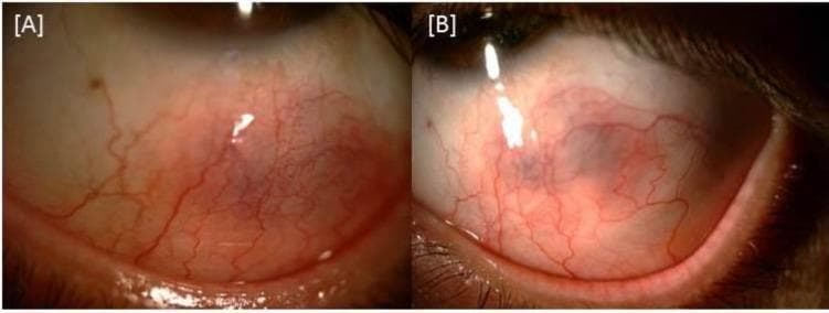 This clinical comparison chart consists of two side-by-side slit-lamp photographs (labeled A and B) documenting the progression and resolution of nodular anterior scleritis in a patient's left eye. Image A shows the eye one week after starting systemic treatment, demonstrating a distinct, elevated scleral nodule characterized by a deep purplish/violaceous hue. There is significant overlying episcleral and conjunctival vascular injection, with engorged, tortuous vessels radiating from the inflammatory site. Image B depicts the same eye three weeks after treatment initiation, illustrating a notable clinical improvement. The purplish hue has significantly faded, the nodular elevation has flattened, and there is a visible reduction in vascular engorgement and perilimbal hyperemia. This comparison serves as a clinical timeline for the response of scleritis associated with Behçet’s disease to immunosuppressive and corticosteroid therapy. The visual features highlighted are critical for differentiating nodular scleritis from simpler episcleritis, specifically the characteristic 'bluish' tint visible in natural light indicating deep scleral involvement.