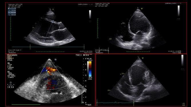 This diagnostic image composite features four echocardiographic views (transthoracic ultrasound) illustrating diverse cardiac pathologies associated with cardiogenic shock. The top left and right panels show parasternal long-axis and apical views of a severely dilated left ventricle (LV) with marked wall thinning and impaired contractility, characteristic of dilated cardiomyopathy; an echogenic mass is visible at the LV apex, diagnostic of a ventricular thrombus. The bottom left panel utilizes color Doppler imaging to demonstrate blood flow into a narrow-necked extracardiac pouch, consistent with a left ventricular pseudoaneurysm following myocardial infarction. The bottom right panel displays an apical view of an apical aneurysm or pseudoaneurysm containing extensive intraluminal thrombosis. This comparison chart serves as an educational tool for identifying mechanical complications of myocardial infarction and chronic heart failure, emphasizing the role of echocardiography in diagnosing intracardiac masses and wall motion abnormalities that may contraindicate certain mechanical circulatory supports.
