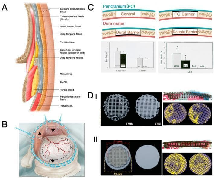 Educational panel illustrating cranial surgical anatomy and bone regeneration research. Panel A: A cross-sectional anatomical diagram of the calvarial and temporal regions labeling multiple soft tissue layers, including the skin, subcutaneous tissue, temporoparietal fascia (SMAS), loose areolar tissue, deep temporal fascia, temporalis muscle, and fat pads. Panel B: A surgical illustration of a craniectomy, showing reflected scalp and dissected temporalis muscle over the dura mater. Panel C: Scientific schematic and bar charts evaluating the inhibitory effects of mechanical barriers (pericranium and dural barriers) on bone regeneration in rat cranial defects. Panel D: Pre-implantation photographs and post-surgical histology of β-TCP scaffolds used in rabbit models. Sub-panels I (porous cap) and II (solid cap) display circular lattice scaffolds, Stevenel’s blue/Van Gieson staining (SVG) for tissue differentiation (mineralized bone in red, soft tissue in blue), and micro-CT reconstructions highlighting new bone formation in yellow at 8 weeks post-operation. This visual resource is designed for advanced learners in neurosurgery and tissue engineering.