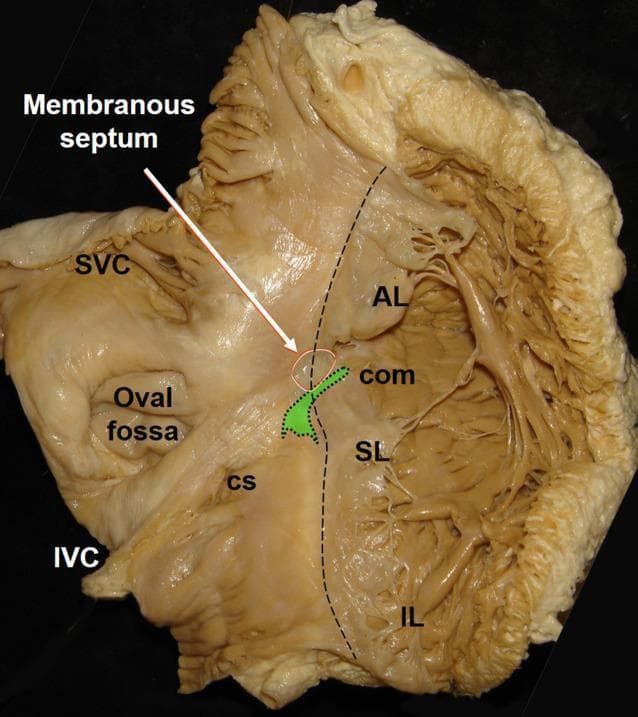 An anatomical gross specimen photograph of a human heart interior, viewed from the right atrium to illustrate the cardiac conduction system landmarks and the tricuspid valve. The atrioventricular (AV) node is highlighted in green, positioned on the atrial side of the septum within the triangle of Koch. It is located anterior to the coronary sinus (CS) ostium and superior to the insertion of the tricuspid valve's septal leaflet (SL). The distal portion of the AV node transitions into the His bundle, pointing toward the commissure (com) between the septal and anterior leaflets (AL). The membranous septum is indicated by a white arrow and circle, marking the region where the His bundle perforates the fibrous skeleton. Other visible structures include the inferior vena cava (IVC), superior vena cava (SVC), oval fossa, and the inferior leaflet (IL) of the tricuspid valve. This clinical anatomical view is essential for understanding electrophysiology and guiding lead placement in His bundle pacing.