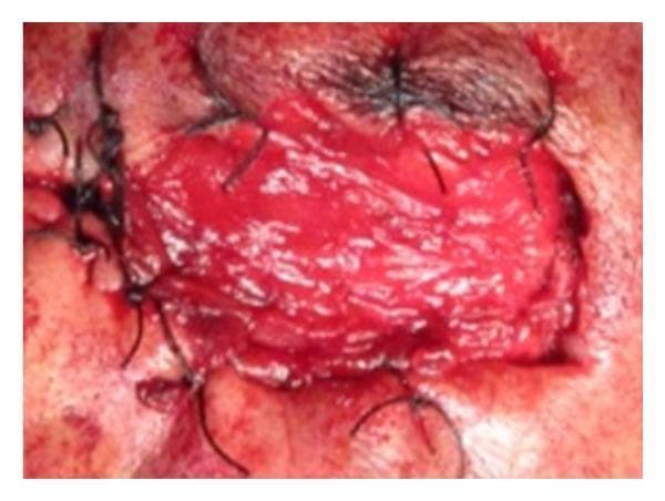 This clinical intraoperative photograph displays a reconstructive surgical procedure following orbital exenteration for squamous cell carcinoma. The image shows a pedicled temporalis muscle flap that has been medially transposed to fill the left orbital cavity. The muscle flap is characterized by its bright red, vascularized, and striated texture. It is secured into the defect using multiple black non-absorbable sutures, which are visible around the perimeter of the flap, anchoring it to the skin of the supraorbital region, the bridge of the nose, and the maxillary buttress. This surgical technique is utilized to provide vascularized bulk for the obliteration of the orbital socket and to provide a base for subsequent split-thickness skin grafting. The photograph serves as an educational example of maxillofacial reconstructive surgery and the management of extensive periorbital malignancies.