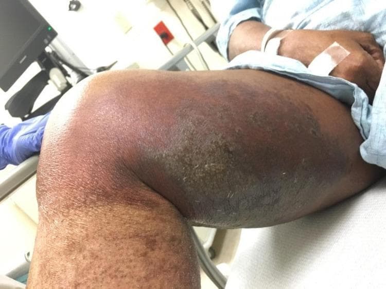 This clinical photograph shows the medial and anterior aspects of the right thigh and knee of a patient in a clinical setting. The image demonstrates a large, confluent area of skin pathology characterized by centrally located hyperkeratotic plaques and evidence of bullous lesions. The central plaques exhibit a thickened, scaly texture with significant hyperpigmentation. Surrounding the central lesions is a broad zone of peripheral erythema, indicating secondary inflammation or cellulitis. The affected area extends from the mid-thigh down toward the knee, showing significant swelling and skin textural changes. This image serves as a clinical example of severe inflammatory dermatosis, potentially lichen planus or pyoderma gangrenosum, with superimposed infection. The presentation highlights the morphological features of hyperkeratosis, plaque formation, and inflammatory erythema in a patient with complex medical comorbidities.