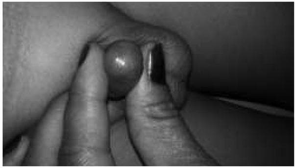 A greyscale clinical photograph depicting a close-up view of a pediatric penis with severe phimosis, classified as Kikiros Grade 5. The image shows the prepuce being manually retracted by an examiner's fingers. The foreskin is tight, non-retractile, and forms a rounded, spherical shape at the distal end, with no visibility of the glans penis or the urethral meatus. The preputial opening is extremely constricted, appearing as a tiny, pinpoint orifice. The skin of the prepuce appears smooth and tense due to the resistance against retraction. This visual serves as a diagnostic reference for severe physiological or pathological phimosis in pediatric urology, illustrating the highest degree of preputial non-retractability where the foreskin is completely tight and the glans is entirely obscured.