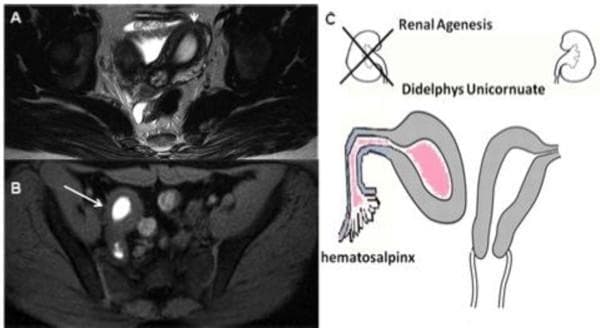This composite educational material demonstrates Mullerian duct anomalies (MDA). Figure A is an axial T2-weighted MRI scan showing an asymmetrical uterine morphology with heterogeneous signal intensity, indicating a deviated endometrial cavity. Figure B is an axial fat-saturated T1-weighted MRI scan revealing a localized area of high signal intensity (hyperintense) within a rudimentary uterine horn, consistent with methemoglobin from blood degradation products (hematometra). Figure C is a clinical illustration summarizing the findings: a didelphys/unicornuate uterus with an obstructed, non-communicating right horn leading to hematosalpinx. The diagram also correlates this genital anomaly with ipsilateral renal agenesis, a common associated finding in Herlyn-Werner-Wunderlich syndrome or related MDA classifications. This content is designed for medical education regarding diagnostic imaging of congenital female reproductive tract malformations and the importance of screening for associated renal variations.