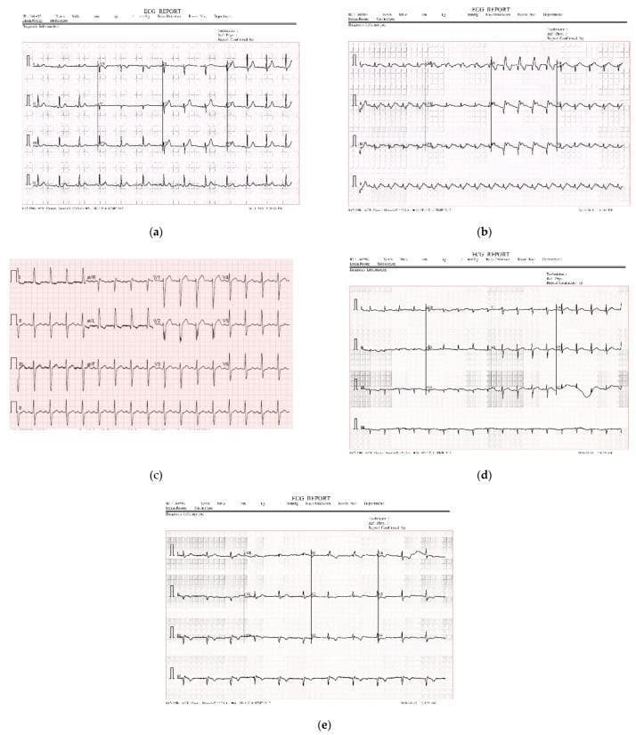 A composite diagnostic image featuring five paper-based 12-lead electrocardiogram (ECG) reports (labeled a through e). The collection demonstrates varying cardiac conditions including Normal Heart Beat (NHB), Myocardial Infarction (MI), COVID-19, Abnormal Heart Beat (AHB), and History of Myocardial Infarction (HMI). Each report displays the standard 12-lead arrangement—I, II, III, aVR, aVL, aVF, and V1-V6—plotted on standard pink or gray grid paper. The visuals exhibit typical ECG components: P waves, QRS complexes, and T waves. The dataset illustrates common challenges in digitizing paper-based medical records, such as varying signal-to-noise ratios, differences in contrast between the waveform and background grid, baseline wander, and potential artifacts from scanning. These images serve as educational materials for clinical cardiology and provide a basis for developing deep learning algorithms for automated cardiac disease classification and digital signal preprocessing.
