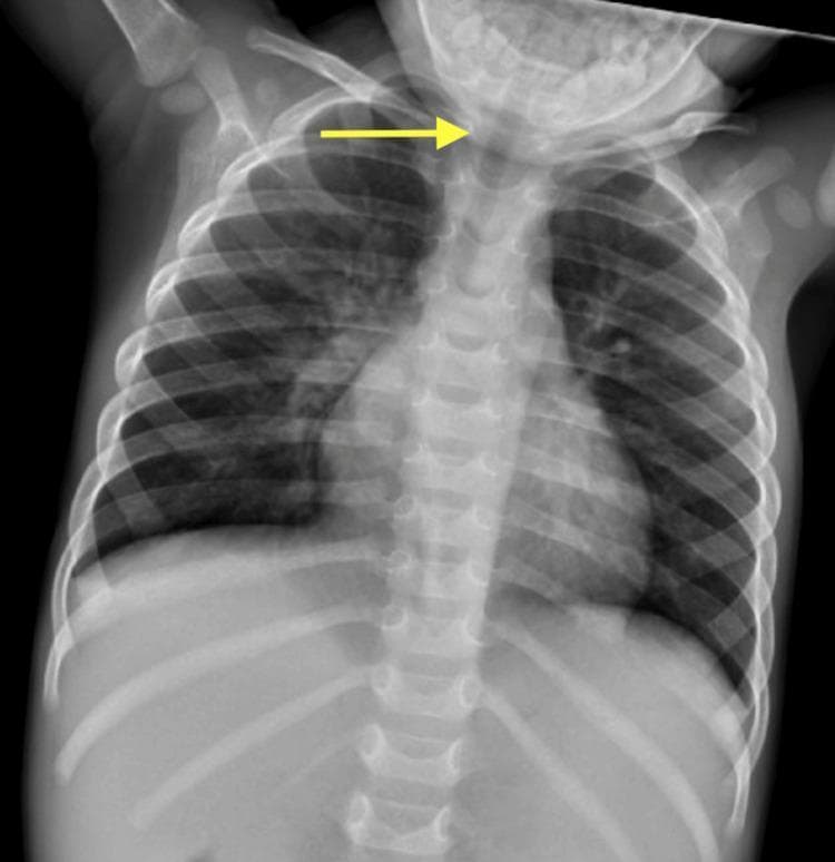 Anteroposterior (AP) pediatric chest radiograph demonstrating findings of subglottic stenosis. The image displays the thoracic cage, including the ribs, clavicles, and mediastinum. A prominent yellow arrow indicates a localized narrowing of the air column in the subglottic region and upper trachea, characteristic of the 'steeple sign' frequently associated with croup (laryngotracheobronchitis) or structural subglottic narrowing. Inferior to the level of narrowing, the mid-to-lower distal trachea appears to maintain a more normalized caliber. The visualized lung fields are relatively clear, without evidence of consolidation, significant opacities, or pleural effusions. This diagnostic image illustrates the radiological assessment of airway diameter in a pediatric patient following critical care for respiratory distress, serving as a teaching tool for identifying upper airway obstruction and evaluating clinical improvement or persistence of tracheal stenosis.
