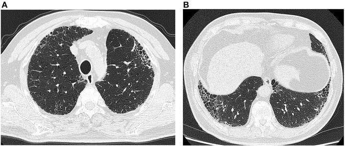 High-resolution computed tomography (HRCT) of the chest in axial view at two different levels (A: upper/mid-thorax, B: lung bases). The images demonstrate bilateral, symmetric pulmonary abnormalities characteristic of a usual interstitial pneumonia (UIP) pattern. Key findings include prominent reticular opacities and peripheral, subpleural honeycombing, particularly evident in the subpleural regions of both lungs. There is a clear predilection for the proximal pleural parts and the lung bases, with relative sparing of the more central lung parenchyma. No significant ground-glass opacities, consolidations, or exudative changes are observed. The presence of these structural alterations—specifically honeycombing and architectural distortion—is highly suggestive of chronic fibrosing interstitial lung disease, such as idiopathic pulmonary fibrosis (IPF). These findings are essential for medical learners to recognize the diagnostic hallmarks of UIP on CT imaging.