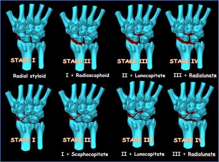 An anatomical diagram and comparison chart illustrating the progressive stages of Scapholunate Advanced Collapse (SLAC) and Scaphoid Nonunion Advanced Collapse (SNAC). The visual uses light blue 3D skeletal models of the wrist and hand against a black background, with red highlights indicating areas of arthritic degeneration and joint space narrowing. The top row depicts the four stages of SLAC: Stage I involves the radial styloid; Stage II extends to the radioscaphoid joint; Stage III adds lunocapitate joint involvement; and Stage IV includes pancarpal arthritis affecting the radiolunate joint. The bottom row depicts the four stages of SNAC: Stage I involves the radial styloid; Stage II progresses to the scaphocapitate joint; Stage III involves the lunocapitate joint; and Stage IV results in radiolunate joint involvement. This educational resource demonstrates the predictable pattern of carpal instability and subsequent secondary osteoarthritis in the wrist, highlighting the preservation of the radiolunate joint until the final stage in both conditions.