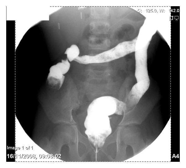 This abdominal diagnostic image is an X-ray radiography showing a Gastrografin enema examination of the large intestine. The contrast study reveals a significant loss of normal haustral folds throughout the visualized segments of the colon, resulting in a smooth, tubular appearance often referred to as a 'lead pipe' appearance. There is evidence of mucosal thickening and fine contour irregularities consistent with small ulcerations. The primary educational focus is to demonstrate the radiological features of chronic inflammation or pancolitis, where the loss of haustration indicates severe or long-standing inflammatory bowel disease. Anatomical landmarks include the rectum, descending colon, transverse colon, and ascending colon, all of which appear narrow and devoid of their typical segmented structure. This visual is characteristic of conditions such as Ulcerative Colitis, where continuous mucosal inflammation leads to structural remodeling of the colonic wall.
