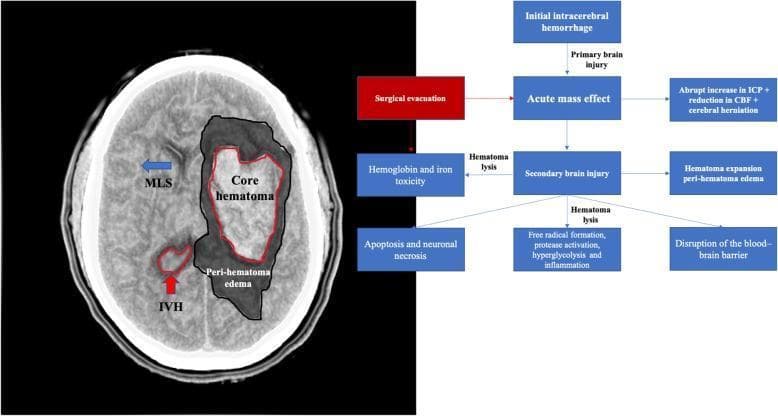 A composite medical illustration containing an axial non-contrast CT scan of the brain and a pathophysiology flowchart detailing the mechanisms of secondary brain injury following intracerebral hemorrhage (ICH). The CT scan (left) demonstrates a large hyperdense intraparenchymal hematoma (labeled 'Core hematoma') with a surrounding hypodense area of 'Peri-hematoma edema'. Significant mass effect is visualized, including midline shift (MLS) indicated by a blue arrow and intraventricular hemorrhage (IVH) marked with a red arrow. The flowchart (right) illustrates the progression from initial ICH through acute mass effect to secondary brain injury. It details biochemical and cellular consequences such as hematoma lysis, hemoglobin and iron toxicity, blood-brain barrier disruption, and free radical formation, culminating in apoptosis and neuronal necrosis. A 'Surgical evacuation' intervention is highlighted in red, positioned as a treatment to mitigate the acute mass effect and subsequent cascade of secondary injury. This image is designed for neurosurgical and radiological education regarding the mechanical and biological impacts of hemorrhagic stroke.