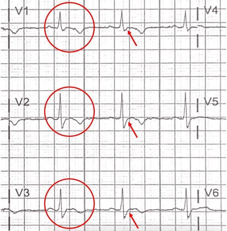 This diagnostic image displays a focused 12-lead electrocardiogram (ECG) tracing specifically highlighting the precordial leads V1 through V6. The visual focuses on the right precordial leads (V1, V2, and V3), which are marked with red circles and arrows to indicate diagnostic abnormalities. Key morphological features include prominent T-wave inversions in leads V1-V3, while the lateral leads V4-V6 show upright T-waves. A critical finding is the presence of an 'epsilon wave,' identified as a small positive deflection or notch at the terminal end of the QRS complex, occurring between the end of the S-wave and the start of the T-wave. These electrocardiographic signs—T-wave inversion in right precordial leads beyond V1 and the presence of epsilon waves—are highly characteristic of Arrhythmogenic Right Ventricular Cardiomyopathy (ARVC). This image serves as a clinical teaching tool for identifying subtle depolarization and repolarization abnormalities associated with fibrofatty replacement of the right ventricular myocardium.