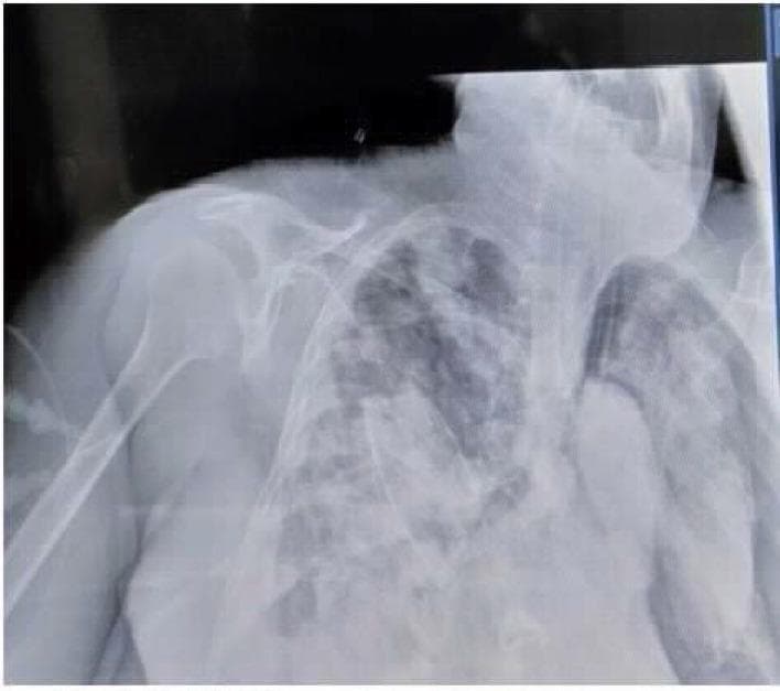 This diagnostic image is an anteroposterior (AP) chest X-ray demonstrating a significant left-sided pneumothorax. The primary finding is a large area of hyperlucency in the left hemithorax with a complete absence of peripheral bronchovascular lung markings. A distinct, thin white line representing the visceral pleural edge is visible, indicating that the left lung has partially collapsed toward the hilum. The contralateral (right) lung field exhibits patchy, bilateral opacities consistent with underlying parenchymal disease such as pneumonia or ARDS. An endotracheal tube is in situ, along with external monitoring leads. Anatomical landmarks including the clavicles, ribs, and humerus are partially visualized, though the patient's position and underlying pathology obscure mediastinal and cardiac contours. This image serves as a clinical example of barotrauma or secondary spontaneous pneumothorax in a critically ill patient, highlighting the radiographic necessity of identifying the visceral pleural line for definitive diagnosis.