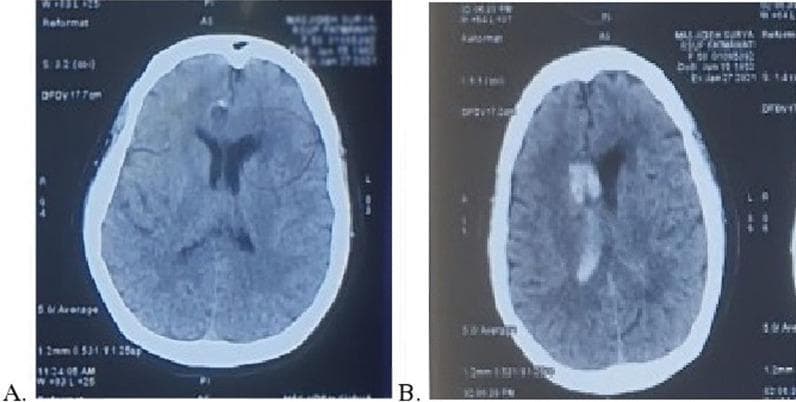 This diagnostic image consists of two axial non-contrast brain CT scans (labeled A and B) demonstrating the progression of an acute cerebrovascular event. Scan A (pre-thrombolysis) shows a subtle area of hypodensity in the left cerebral hemisphere, specifically involving the left external capsule and the anterior horn of the lateral ventricle, consistent with early ischemic infarction. Scan B (post-thrombolysis) reveals a significant change in pathology: high-attenuation (hyperdense) areas are now visible within the ventricular system, particularly in the right lateral and third ventricles. This hyperdensity indicates acute intraventricular hemorrhage (IVH), representing a hemorrhagic transformation following the administration of intravenous tissue plasminogen activator (tPA). The comparison illustrates the potential complication of intracranial bleeding during reperfusion therapy for ischemic stroke. This material is suitable for neurology and radiology education regarding stroke management and associated risks.