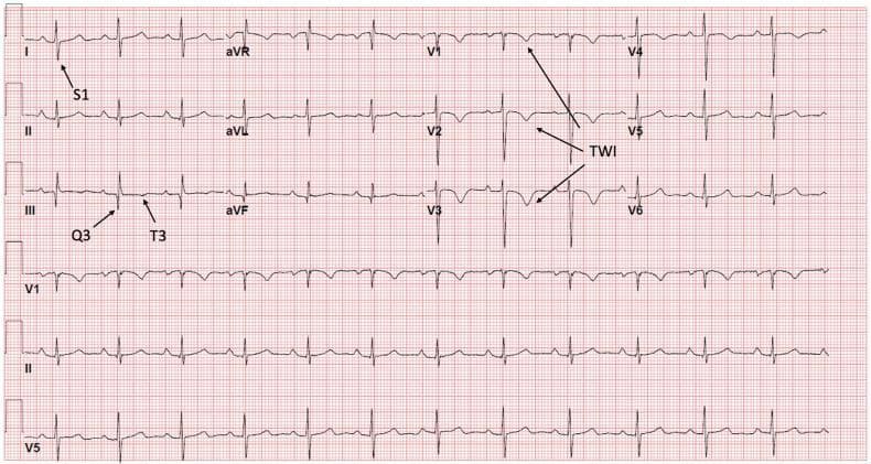 Diagnostic Image: A 12-lead electrocardiogram (ECG) displayed on a standard red grid, demonstrating classic features associated with acute right ventricular (RV) strain. The tracing shows a sinus rhythm with several key diagnostic findings. In the limb leads, an S1Q3T3 pattern is visible, marked with labels: a deep S-wave in lead I (S1), a pathological Q-wave in lead III (Q3), and an inverted T-wave in lead III (T3). In the precordial leads, there are prominent, deep, symmetric T-wave inversions (TWI) extending from V1 through V6, which are also highlighted with arrows. These visual markers collectively illustrate the McGinn-White sign, often associated with acute pulmonary embolism. The ECG serves as an educational tool for recognizing the cardiovascular manifestations of increased right-sided heart pressure and strain.
