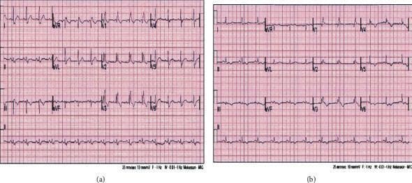 This diagnostic image displays a side-by-side comparison of two 12-lead electrocardiograms (ECG) from a 55-year-old patient, demonstrating the cardiovascular manifestations of acute pulmonary embolism (PE) and subsequent progression. ECG (a), captured at the time of acute diagnosis, shows sinus rhythm with a heart rate of approximately 90 bpm and a classic right ventricular (RV) strain pattern. Key features include a right bundle branch block (RBBB) with an rSR' pattern in lead V1, slurred S waves in lead V6, and the S1Q3T3 pattern (deep S wave in lead I, Q wave in lead III, and inverted T wave in lead III). Inverted T waves are also prominent in the anterior precordial leads (V1-V3). ECG (b), taken five days later during ICU recovery, shows persistent RBBB with a slightly widened QRS duration (~150 ms) and evolving diffuse T-wave changes across the precordial leads. The comparison highlights the utility of serial ECG monitoring in identifying RV strain secondary to pulmonary vascular obstruction and tracking the resolution of electrophysiological abnormalities following thrombolytic therapy.