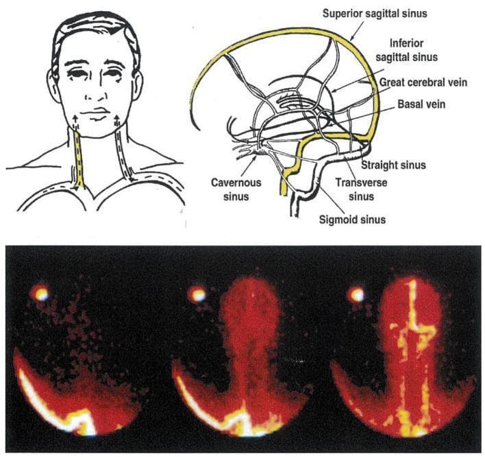 This composite educational graphic details the cerebral venous sinus system through schematic illustrations and diagnostic imaging. The upper panel includes a sagittal anatomical diagram labeling the superior and inferior sagittal sinuses, great cerebral vein, basal vein, straight sinus, cavernous sinus, transverse sinus, and sigmoid sinus. An accompanying coronal sketch shows the bilateral internal jugular veins in the neck. The lower panel displays a Technetium-99 radioisotope scan (scintigraphy) of the dural sinuses from a posterior view, illustrating a lateralized drainage pattern. In this clinical example, the superior sagittal sinus—which drains the cerebral cortex—predominantly flows into the right transverse sinus and right internal jugular vein. Simultaneously, the straight sinus—draining deep subcortical structures—flows into the left internal jugular vein. This visualization emphasizes anatomical variations in venous lateralization, which is critical for clinical procedures such as selective jugular venous sampling used to quantify regional brain monoamine turnover.