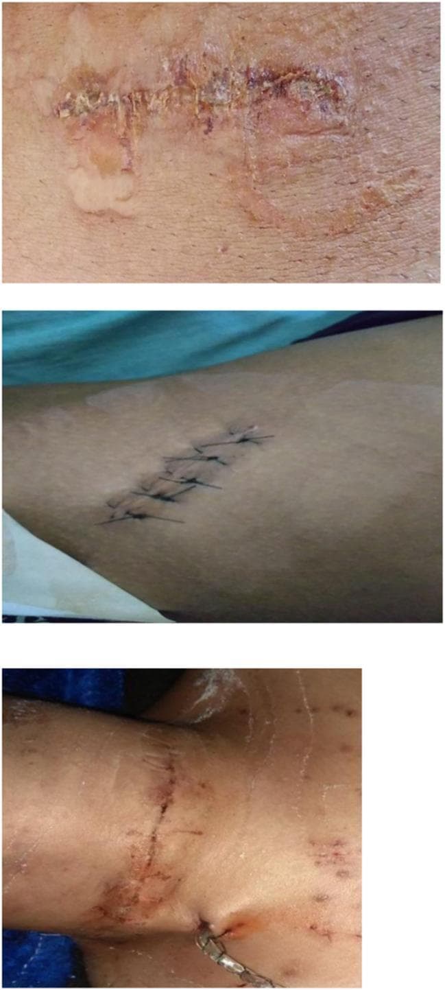 This composite of clinical photographs illustrates various methods of surgical wound closure and their immediate post-operative outcomes. The top image shows a wound closed with topical skin adhesive (cyanoacrylate). The closure exhibits a linear scar with irregular edges, localized erythema, and residual adhesive material on the surrounding skin. The middle image demonstrates a wound closed using a traditional interrupted suture pattern with non-absorbable black sutures. The wound edges are well-approximated with minimal periwound inflammation, signifying primary intention healing. The bottom image shows a linear surgical incision, likely on the neck or torso, also closed with sutures, accompanied by a surgical drain emerging from the inferior aspect of the wound. The surrounding skin displays minor petechiae and moderate post-operative inflammation. These images are used in medical education to compare cosmetic outcomes, healing progress, and complications such as dehiscence or infection between tissue glues and suturing techniques.