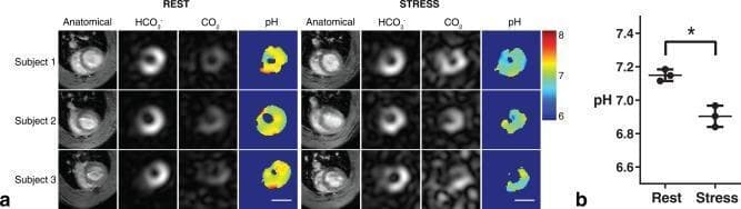 This diagnostic imaging graphic illustrates metabolic cardiac imaging using hyperpolarized 13C MRI to measure intracellular myocardial pH. Panel (a) presents mid-ventricular cross-sectional slices from three subjects under 'Rest' and 'Stress' (dobutamine-induced) conditions. Four image types are displayed for each: 'Anatomical' (standard GRE reference), 'HCO3-' (bicarbonate distribution), 'CO2' (carbon dioxide distribution), and a derived 'pH' map. The pH maps utilize a color scale ranging from blue (pH 6) to red (pH 8). Visually, the 'Rest' maps show warmer colors (yellow/orange), indicating a physiological pH of approximately 7.2. Under 'Stress', there is a noticeable shift toward cooler colors (green/blue), representing myocardial acidification. Panel (b) is a statistical comparison graph showing a significant decrease in mean myocardial pH from approximately 7.15 at rest to 6.90 during stress (p < 0.05). This content demonstrates the use of metabolic imaging to monitor myocardial acid-base balance and response to increased cardiac workload, relevant to cardiovascular physiology and diagnostic radiology.