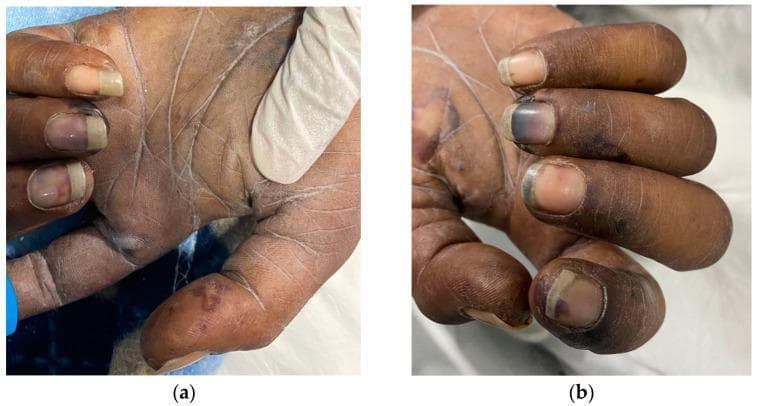 Two clinical photographs (a and b) show the palmar surfaces and fingers of a patient exhibiting peripheral stigmata of infective endocarditis. The palms and fingertips demonstrate multiple Janeway lesions, which appear as non-tender, small, erythematous to violaceous macules and papules. The nail beds of several fingers display splinter hemorrhages, characterized by thin, linear, dark-red to brown streaks running longitudinally under the nail plate. Some digits also show subungual hematomas or dark purplish discoloration near the distal edges, and there is visible bulbous enlargement of the distal phalanges consistent with digital clubbing. The skin texture appears dry with prominent creases and subtle areas of hypopigmentation on the palms. These findings are classic dermatologic manifestations of microembolic or immunologic processes associated with systemic infection, specifically infective endocarditis.