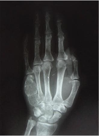 This hand radiograph demonstrates classic skeletal manifestations of secondary hyperparathyroidism. Key diagnostic findings include significant subperiosteal bone resorption localized to the radial aspects of the middle phalanges, characterized by a 'lace-like' appearance and loss of cortical definition. In the fifth metacarpal, there is a prominent brown tumor appearing as a cystic, expansible, well-defined osteolytic lesion. This lesion thins and expands the surrounding cortex without frank penetration or a periosteal reaction. Additional features visible include acroosteolysis (resorption of the distal tufts) and generalized osteopenia. These findings are pathognomonic for high bone turnover states associated with chronic renal failure or primary hyperparathyroidism. The image serves as a high-level educational example of renal osteodystrophy and the progression of metabolic bone disease in clinical practice.