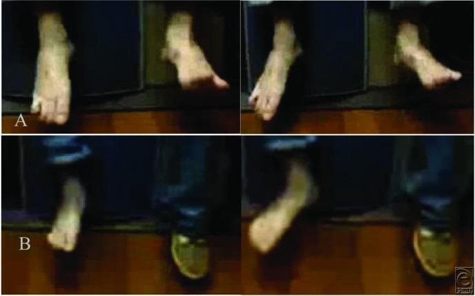 Clinical photograph and comparison chart demonstrating a pre- and post-operative evaluation of foot drop in a 24-year-old male. The content is divided into two rows. Upper panel (A) shows the preoperative state with the right foot exhibiting classic foot drop and steppage gait, characterized by marked plantarflexion, lack of ankle dorsiflexion (BMRC 0/5), and an inability to extend the toes. This is indicative of common peroneal nerve injury following knee surgery. Lower panel (B) presents the postoperative results after peroneal nerve decompression and nerve transfer. It demonstrates significant clinical improvement, showing the foot in a more neutral and dorsiflexed position (BMRC 4/5) with visible toe extension and ankle eversion. This comparison illustrates the restoration of anterior tibialis muscle function and successful surgical intervention for peroneal nerve palsy. The image serves as an educational resource for neurology, orthopedics, and physical therapy students to visualize gait abnormalities and surgical outcomes in peripheral nerve repair.