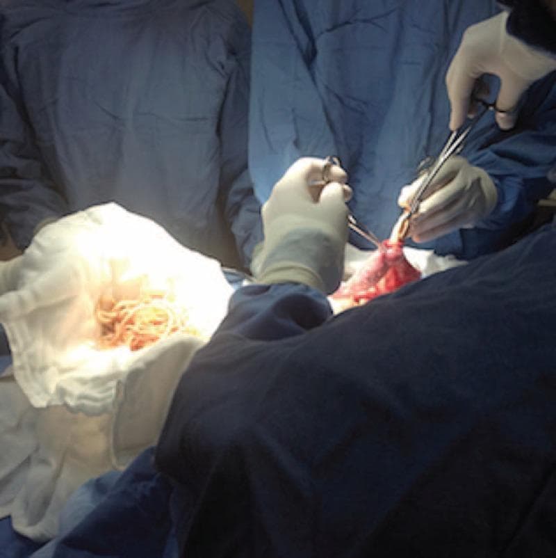 This clinical photograph captures an intraoperative scene during a surgical procedure for intestinal obstruction caused by Ascariasis. The image shows a surgeon and surgical team in sterile blue gowns and gloves performing a laparotomy. The primary focus is on a segment of small intestine (jejunum/ileum) being manipulated with surgical forceps. Adjacent to the surgical field, a large cluster of extracted helminths (roundworms, likely Ascaris lumbricoides) is visible on a white surgical gauze. These worms are numerous, long, cylindrical, and off-white to light tan in color, appearing as a tangled mass. The image demonstrates the surgical technique of milking or manually extracting helminths from the bowel lumen to resolve a mechanical obstruction. This visual serves as a critical educational example of parasitic infestation presenting as an acute surgical abdomen, illustrating the severity of helminthic load that can occur in pediatric patients in endemic regions.