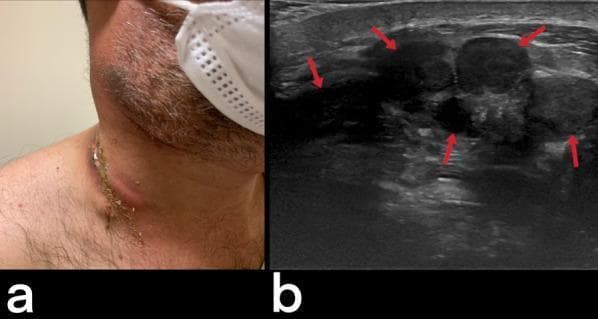 This dual-panel image demonstrates the clinical and radiological presentation of tuberculous cervical lymphadenitis, commonly known as scrofula. Panel (a) is a clinical photograph of a 32-year-old male showing progressive, discrete, and mobile lumps in the lateral neck. A notable finding is the presence of cutaneous fistulization, where an underlying nodal mass has ruptured through the skin, creating a chronic draining sinus tract. Panel (b) is a corresponding ultrasound image of the cervical region. Red arrows highlight multiple enlarged, hypoechoic lymph nodes. These nodes exhibit loss of the normal fatty hilum and internal heterogeneity, characteristic of central caseous necrosis. The correlation between the two panels illustrates the progression from internal nodal necrosis to subcutaneous abscess formation and eventual external fistulization. This presentation is a hallmark of extrapulmonary tuberculosis (EPTB) in endemic regions, emphasizing the importance of considering chronic granulomatous infections in the differential diagnosis of unilateral cervical lymphadenopathy with skin involvement.
