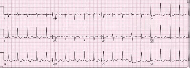 Diagnostic Image: This 12-lead electrocardiogram (ECG) demonstrates atrial flutter with a 2:1 atrioventricular (AV) conduction ratio. The tracing shows highly regular atrial activity with a characteristic sawtooth morphology. In the inferior leads (II, III, and aVF), the flutter waves are distinctly positive (upright), while in lead V1, the flutter waves exhibit a negative (inverted) polarity. This specific polarity patternβupright flutter waves in the inferior leads and inverted in V1βis diagnostic of clockwise typical atrial flutter (atypical by counter-clockwise standards). The QRS complexes are regular and narrow, occurring at approximately half the frequency of the atrial rate (atrial rate ~300 bpm; ventricular rate ~150 bpm). In the precordial leads V4-V6, the QRS and T-wave morphologies are preserved, although discrete P waves are replaced by the undulating flutter baseline. The image illustrates a classic supraventricular tachycardia frequently encountered in cardiology and emergency medicine, serving as an educational example of macro-reentrant atrial rhythms.